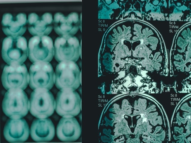MRI brain scans